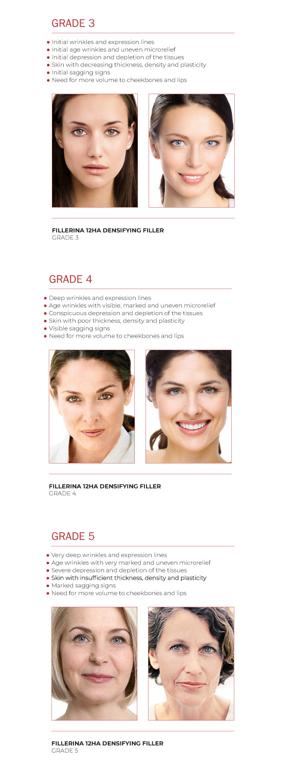 FILLERINA 12 - CHEEKBONES (GRADE 4)