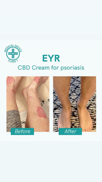 Nordic Oil - CBD Cream - EYR - Psoriasis
